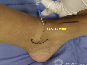 Bloqueo nervio safeno: infiltración de la aguja a 1cm por encima y por delante del maléolo medial.