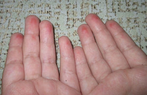 Caso 1: máculas eritematosas en todos los pulpejos de ambas manos.