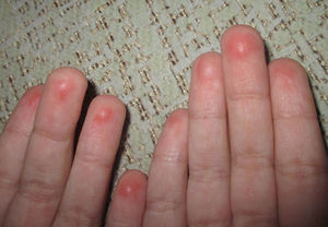 Caso 2: eritema brillante en los pulpejos de ambas manos, con detalle de la atenuación de los dermatoglifos.