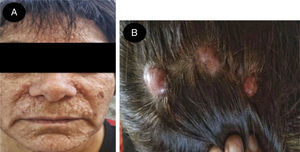A) Pápulas de distribución centrofacial con predominio en el dorso de la nariz y surcos nasogenianos. B) Nódulos de superficie lisa en el cuero cabelludo, asintomáticos.