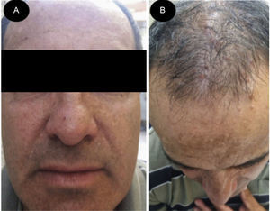 A) Tricoepiteliomas centrofaciales en el hermano. B) Cilindromas incipientes en el cuero cabelludo del hermano. Destaca el menor número de lesiones.