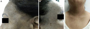 A) Caso 1: AFF con retroceso de la línea de implantación del cabello, pápulas faciales y pérdida de las cejas. Además, máculas hiperpigmentadas difusas correspondientes a LPPigm. B) Caso 2: Se observan cabellos aislados que persisten en la línea de implantación original. C) Caso 2: Máculas hiperpigmentadas en el cuello correspondientes a lesiones de LPPigm.