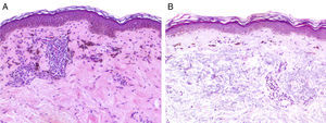 Biopsias de máculas hiperpigmentadas compatibles con liquen plano pigmentoso. A) Caso 1: Infiltrados linfocitarios a nivel perivascular y perianexial con melanófagos en la dermis superior (hematoxilina-eosina 20X). B) Caso 2: Degeneración vacuolar de la membrana basal y melanófagos en la dermis superior (hematoxilina-eosina 10X).