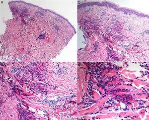 Estudio histológico del segundo caso; a y b: panorámicas de piel en las que se observa edema en la dermis y el tejido celular subcutáneo, además de un infiltrado inflamatorio significativo perivascular e intersticial, hematoxilina/eosina ×10 y ×10; c: numerosos eosinófilos intersticiales entre los haces de colágeno, hematoxilina/eosina ×20; d: detalle de la degranulación eosinofílica adyacente a las fibras colágenas dando lugar a las figuras en llamarada, hematoxilina/eosina ×40.