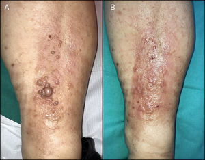 A) Lesiones de EVN previas al tratamiento. B) Buen resultado cosmético un mes después de la segunda sesión de tratamiento con láser CO2.