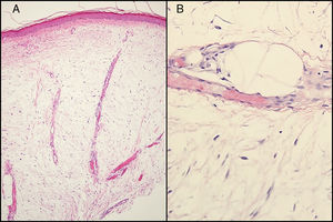 A) Acantosis e hiperqueratosis de le epidermis con marcado edema dérmico (hematoxilina-eosina ×100). B) Se aprecian espacios linfáticos dilatados y proliferación de fibroblastos (hematoxilina-eosina ×400).