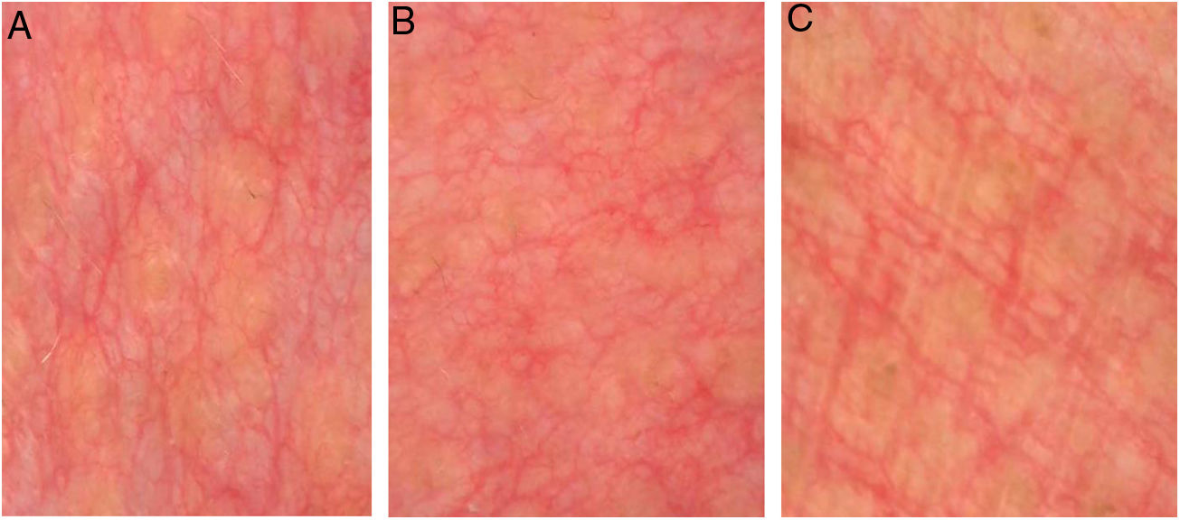 Telangiectasia Macular Eruptiva Perstans PDF Telangiectasia Macularis Telangiectasia Macular Eruptiva Perstans PDF Telangiectasia Macularis