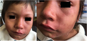 A) Se evidencia asimetría facial marcada de predominio en la hemicara izquierda. B) Malformación vascular macular de bordes irregulares en la hemicara izquierda.
