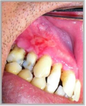 Úlcera dolorosa en mucosa gingival de bordes irregulares, cubierta por una membrana o pseudomembrana amarillento-grisácea, sobre una base eritematosa o blanquecina cicatricial en paciente con PV.