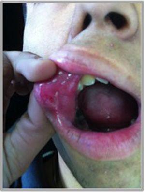 Se observa una úlcera única tipo aftas menores en un paciente con EB. Característicamente presenta un diámetro inferior a 1cm, ubicada en la mucosa no queratinizada del labio superior. Se pueden observar márgenes bien demarcados, con base eritematosa y restos de fibrina en su interior.