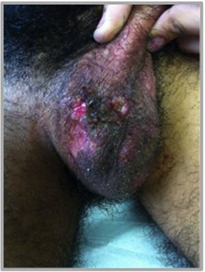 Úlceras genitales en el escroto de un paciente con EB. Nótese el mayor tamaño y profundidad de las lesiones. Estas curan más lentamente, recidivan menos, pero dejan cicatrices.