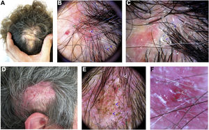 Liquen plano pilar. A) Placa alopécica mal delimitada en el vértex y la zona parietal central. Se observan eritema y descamación. B y C) Tricoscopia: descamación peripilar (flechas verdes), moldes peripilares (flechas azules), eritema y áreas rojo-lechosas sin aperturas foliculares (flechas blancas). Lupus cutáneo discoide. D) Placa alopécica mal delimitada en la región temporal derecha. Se observa eritema y algunas erosiones. E) Tricoscopia: descamación perifolicular (flechas blancas), eritema peri- e interfolicular y múltiples tapones córneos (flechas azules). Además, zonas rojo-lechosas sin aperturas foliculares y vasos gruesos (flechas verdes). F) Tricoscopia: descamación (flechas blancas) y eritema peri- e interfolicular, y vasos arboriformes gruesos (flechas verdes).
