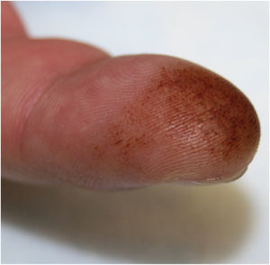 Mácula irregular marrón-ocre en el pulpejo del segundo dedo de la mano derecha.