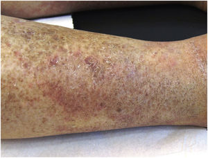 Eccema y xerosis en las extremidades inferiores.