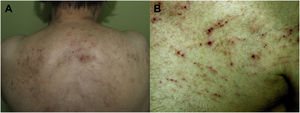 Dermatitis atópica del anciano. A) Lesiones excoriadas en las zonas accesibles al rascado. B) Detalle de las excoriaciones.