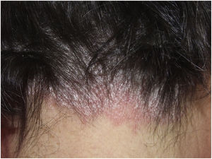 Psoriasis del cuero cabelludo. Placas eritemato-descamativas en la región occipital.