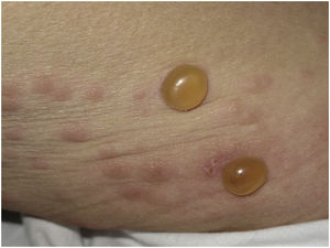 Penfigoide ampolloso. Ampollas tensas sobre placas urticariales.