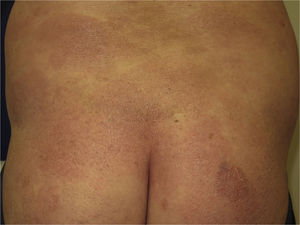 Micosis fungoides en placas. Lesiones eritemato-descamativas en el tronco y en la región glútea.