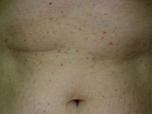 Enfermedad de Grover. Pápulas eritematosas muy pruriginosas de predominio en el tronco.