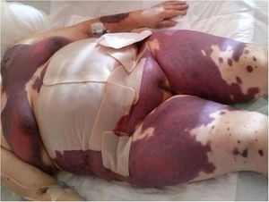 Púrpura fulminante: grandes placas equimóticas y máculas eritematovioláceas que comprometen casi toda la superficie cutánea, al tercer día del inicio de las lesiones.