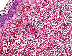 Imagen histopatológica de la biopsia que muestra vasos dérmicos de mediano y pequeño calibre con material fibrino-hemático en su interior (HE 20x).