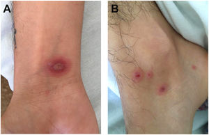 A y B) Lesiones eritematosas en diana localizadas en las manos y los pies.