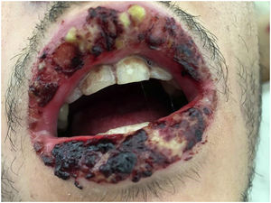 Lesiones ulceradas que afectan la semimucosa y la mucosa del labio superior e inferior.