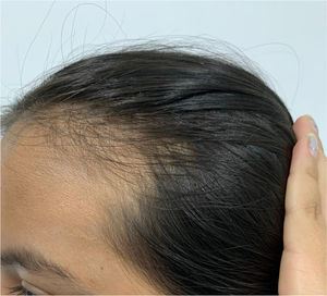 Reducción de la densidad pilosa en la región temporoparietal con aumento de pelos vellosos.