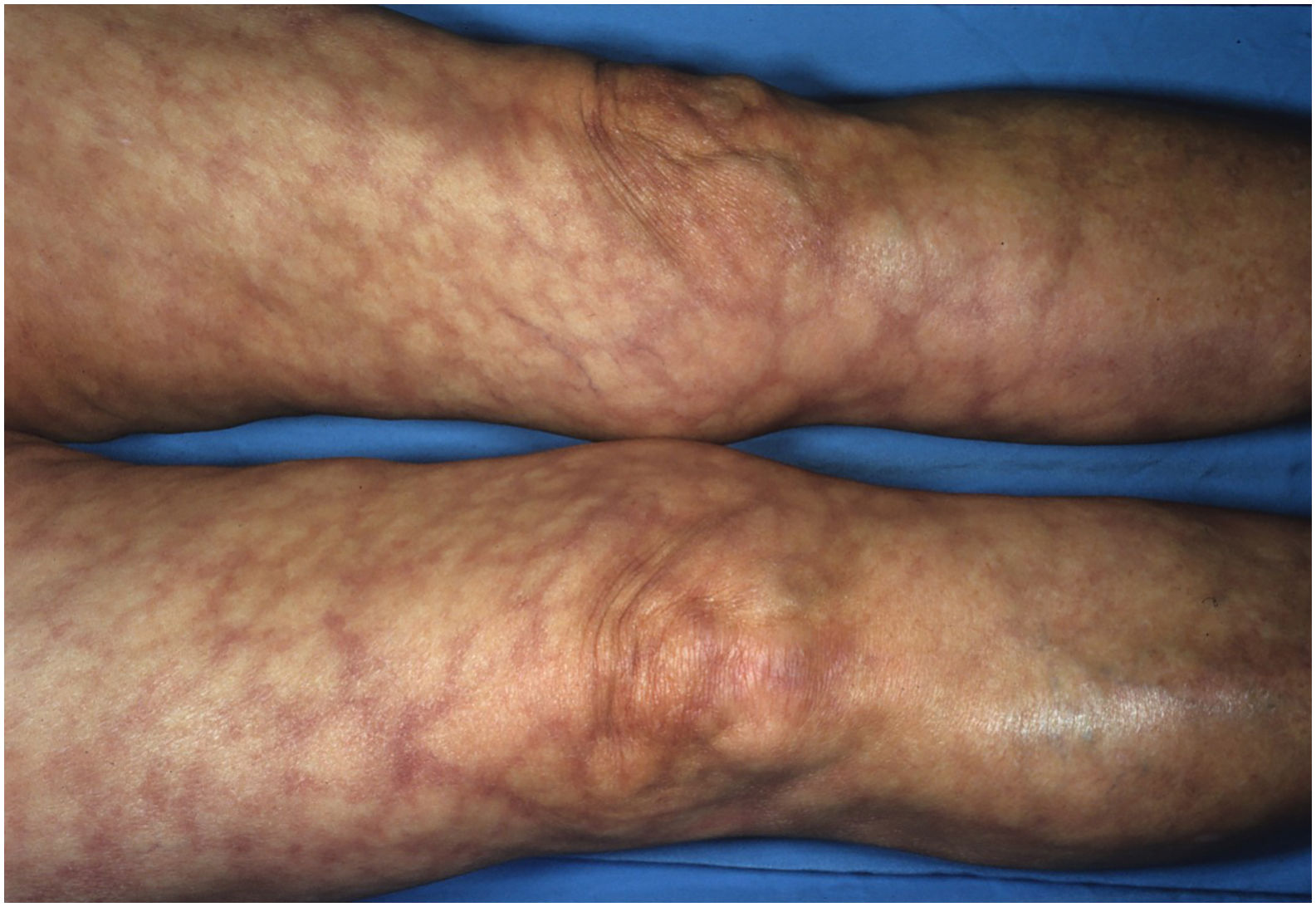 Piel Reticulada Púrpura retiforme | Piel. Formación continuada en dermatología