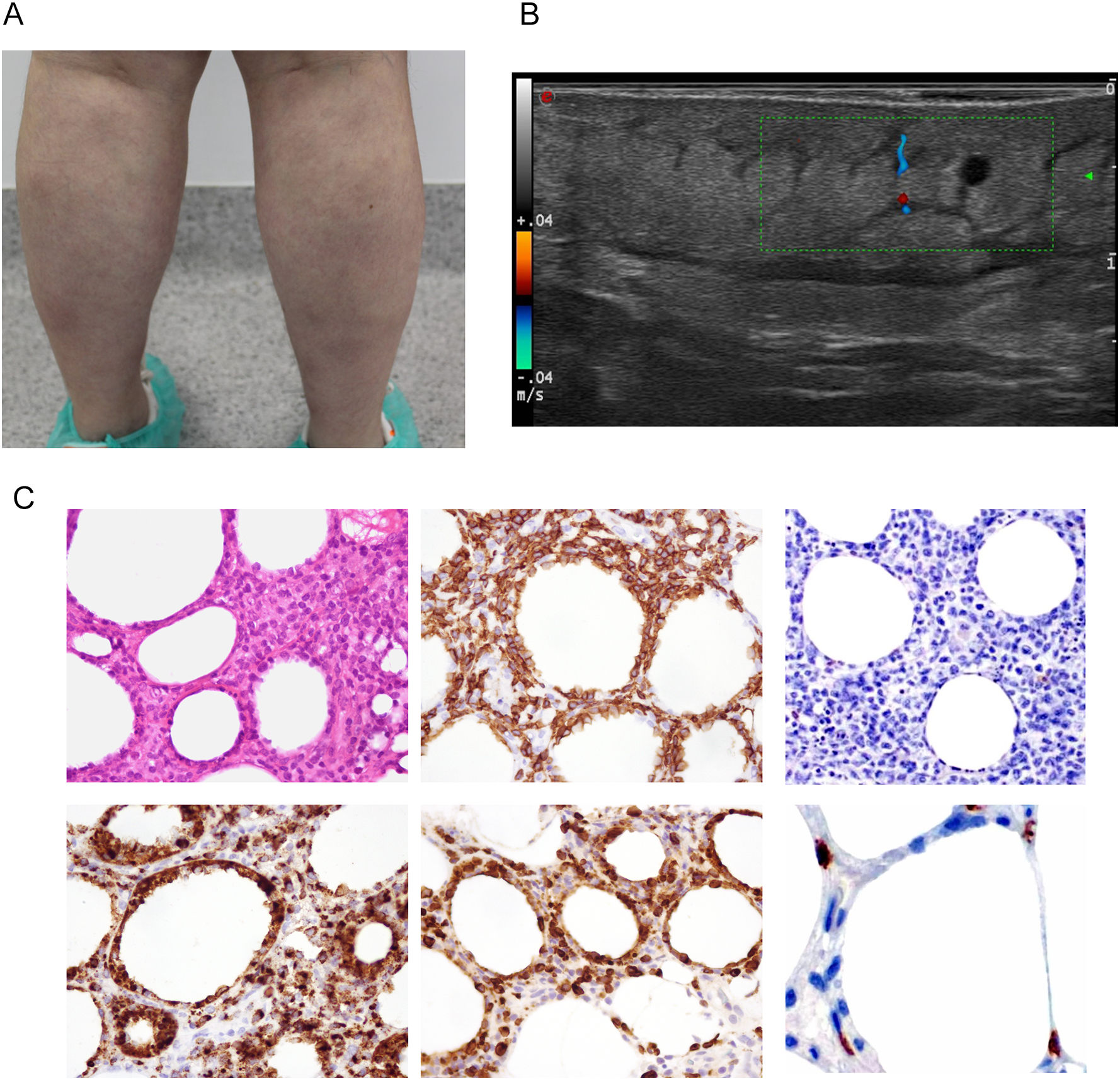 Linfomas T cutáneos primarios con afinidad por el panículo adiposo ...