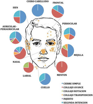 Distribución de los carcinomas basocelulares tratados con cirugía micrográfica de Mohs. Cada círculo naranja representa un único tumor. Los gráficos circulares representan la frecuencia de los diferentes tipos de cierre utilizados en las distintas áreas anatómicas de la cabeza y el cuello.