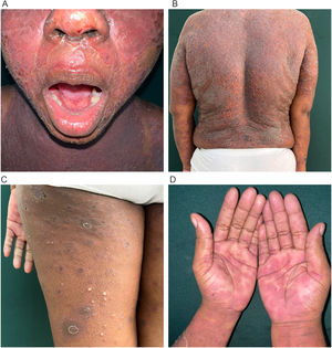 Fotografías clínicas. A) Placas urticariales anulares en la cara, sin compromiso mucoso. B) Placas urticariales, descamativas, anulares y circinadas en la espalda, con presencia de escasas pústulas y ampollas. C) Placas urticariales anulares en la región posterior del muslo izquierdo, con pústulas con nivel. D) Placas eritematosas en diana en las palmas.