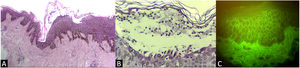 Histopatología. A) Ampolla subcórnea (H&E, 10X). B) Ampolla subcórnea con neutrófilos en su interior (H&E, 40X). C) Inmunofluorescencia directa IgG que muestra un patrón epidérmico en red (40X).
