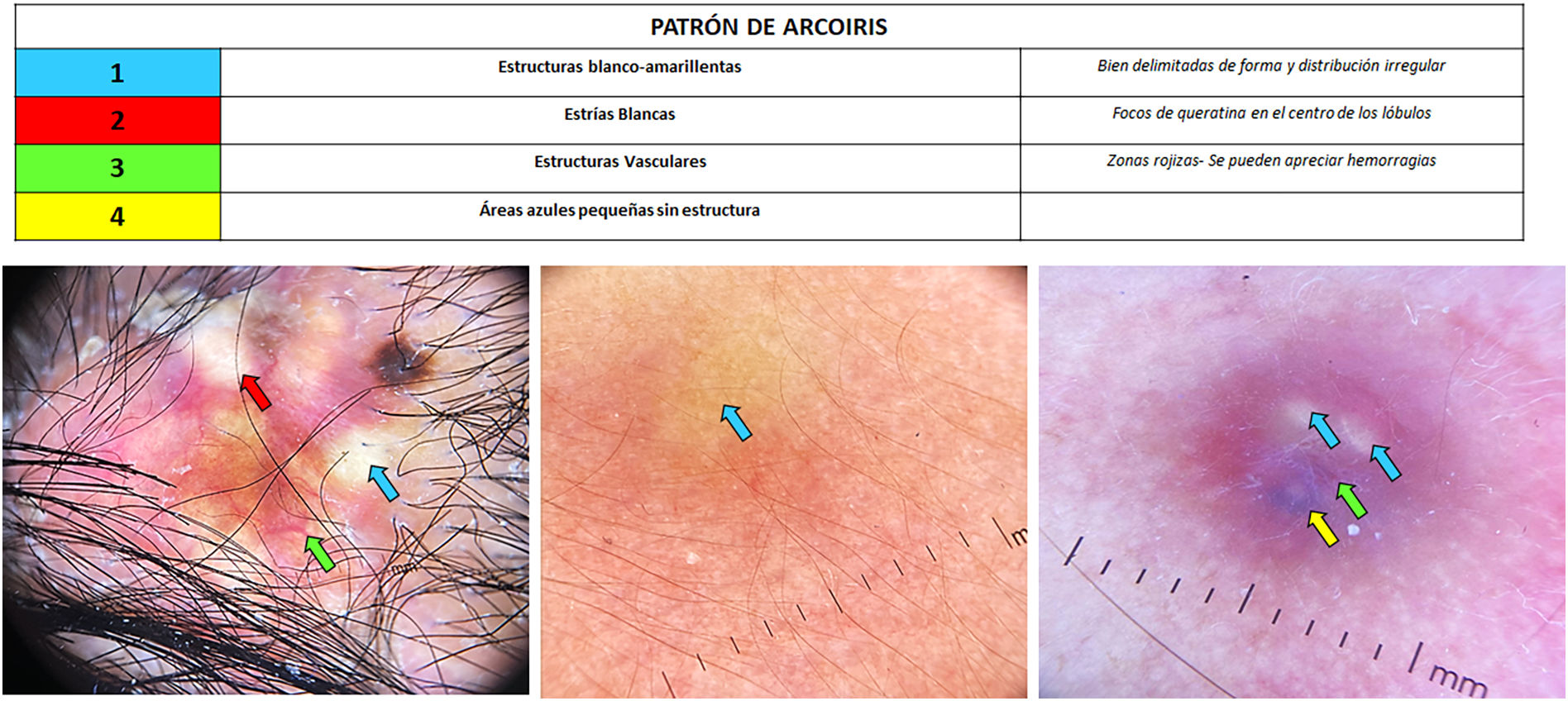 Hallazgos Dermatosc picos En El Pilomatricoma Piel Formaci n hallazgos-dermatosc-picos-en-el-pilomatricoma-piel-formaci-n