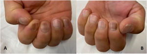 A) Hallazgos ungulares de la mano derecha. B) Hallazgos ungueales de la mano izquierda.