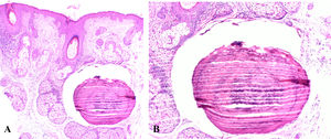 Biopsia de piel que muestra un infiltrado inflamatorio linfocitario perianexial y un nódulo bien circunscrito de hueso lamelar.