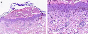 Imagen histológica: A) epidermis delgada, pústula subcórnea con infiltrado de polimorfonucleares asociado a infiltrado inflamatorio linfocitario y perivascular en la dermis (H&E 10X). B) Detalle del infiltrado inflamatorio (H&E 40X).