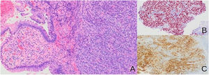 Biopsia de la tumoración rectal: A) células grandes de núcleos ovales, nucléolos dispuestos en sabanas con figuras de mitosis atípicas con infiltración de la totalidad del espesor (H&E 10X). B) Tinción inmunohistoquímica SOX10 que muestra células tumorales con tinción nuclear (4X). C) Tinción inmunohistoquimica Melan A que muestra células tumorales con tinción citoplasmática (4X).