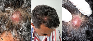 Hallazgos clínicos. A, B y C) En la región frontoparietal derecha del cráneo se observa un nódulo eritematoso, brillante, circunscrito, de 20 milímetros.