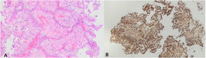 Histopatología. A) En la dermis nidos de células de citoplasma claro, con membrana aparente, que se disponen en forma de arborización, con núcleos hipercromáticos, algunos de ellos pleomórficos. B) Tinción de CD 10 fuertemente positiva.