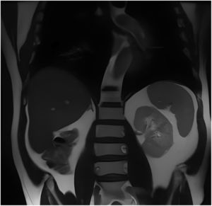 Resonancia magnética abdominal. Cambios debidos a nefrectomía derecha. No hay signos de recidiva tumoral ni extensión de la enfermedad al abdomen.