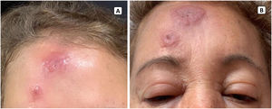 A) Placas eritematosas, infiltradas, de bordes elevados, localizadas en región frontal derecha. B) Nótese el edema comprometiendo la región frontal, el puente nasal y los párpados.