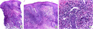 Histopatología: A) Infiltrado inflamatorio denso que respeta la epidermis y afecta la dermis superficial y profunda. B) Presencia de una zona Grenz respetada por el infiltrado inflamatorio, el cual rodea las estructuras anexas sin destruirlas. C) Detalle del infiltrado inflamatorio mixto con presencia de eosinófilos, linfocitos, histiocitos y neutrófilos. Se aprecia extravasación eritrocitaria y edema endotelial sin cambios de vasculitis.