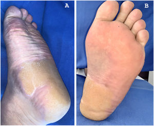 A) Hiperqueratosis plantar previa a cambios en la dieta. B) Mejoría de la hiperqueratosis plantar tras la restricción dietética de fenilalanina y tirosina.