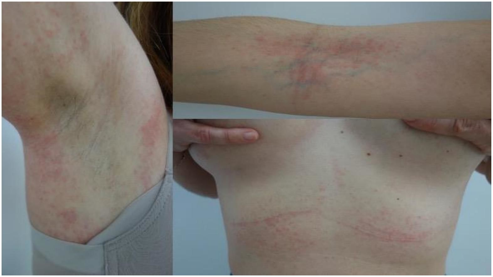 Recurrencia del síndrome DRESS (Drug Rash with Eosinophilia and ...