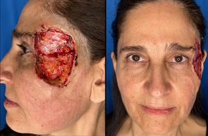 Defecto de 72 x 48 mm, tras la escisión con cirugía de Mohs de un carcinoma basocelular.