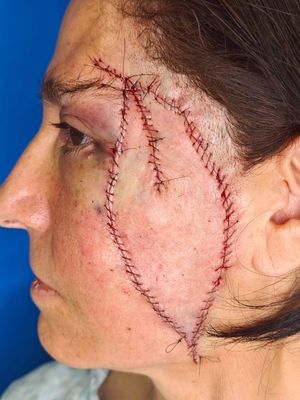 Aspecto de la reconstrucción en el posquirúrgico inmediato.