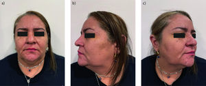 Resultados postratamiento. a–c) Se evidencia la eliminación de las lesiones previamente descritas.