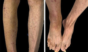 A) Lesiones purpúricas foliculares no palpables en ambas piernas. B) Cambios de ictiosis en ambos pies.