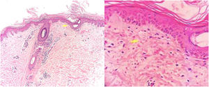 Histopatología: A) tapones de queratina en el ostium infundibular (H&E, 10x). B) Extravasación de eritrocitos en la dermis perifolicular y papilar (H&E, 20x).